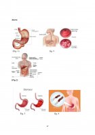 Atestat Îngrijirea pacientului cu gastrită acută - imaginea37